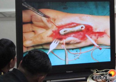 В Таиланде проведена первая в мире пересадка кости