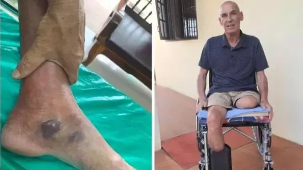 Укус комара в Таиланде стоил потери обеих ног